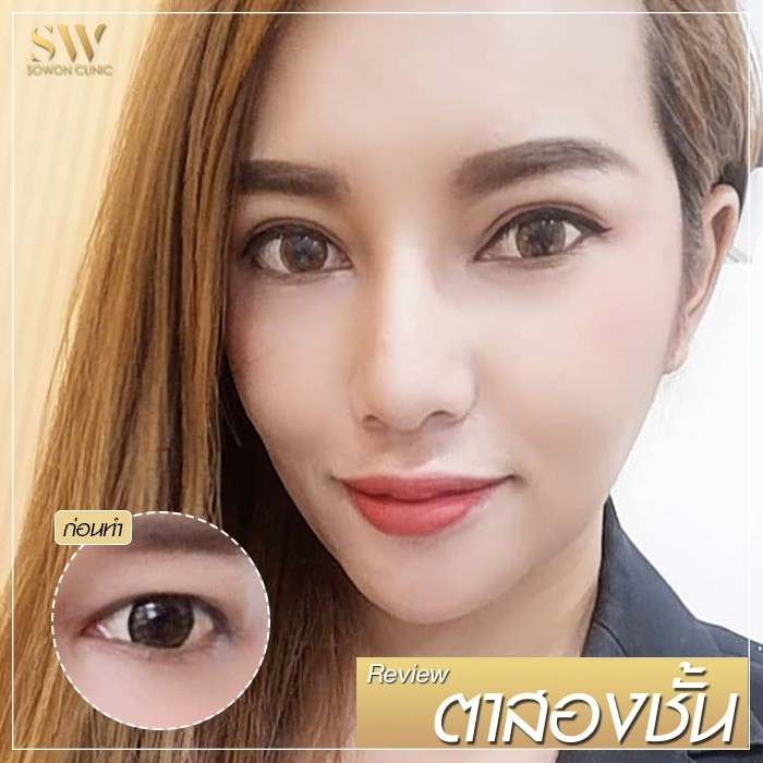 ตาสองชั้น เปลี่ยนตาปุ๊ป โหงวเฮ้งปังปั๊ป - Sowon Clinic