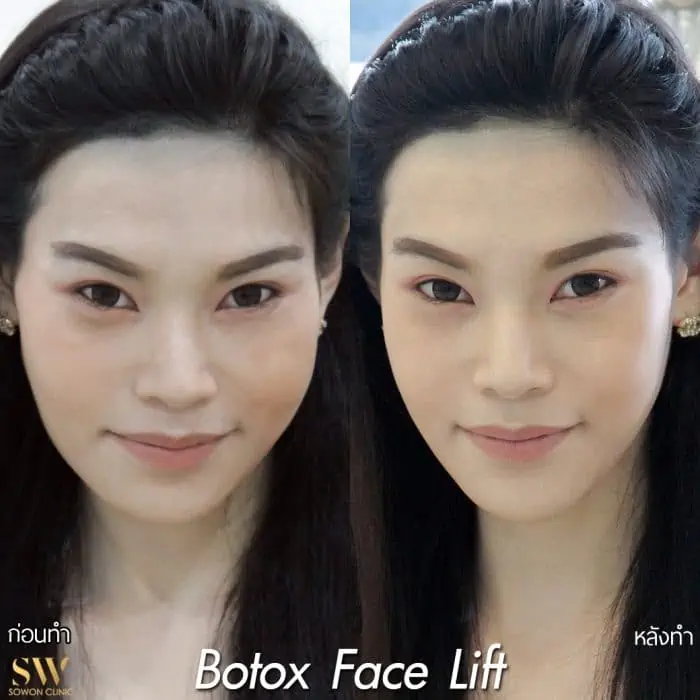 Botox Facelift sowon