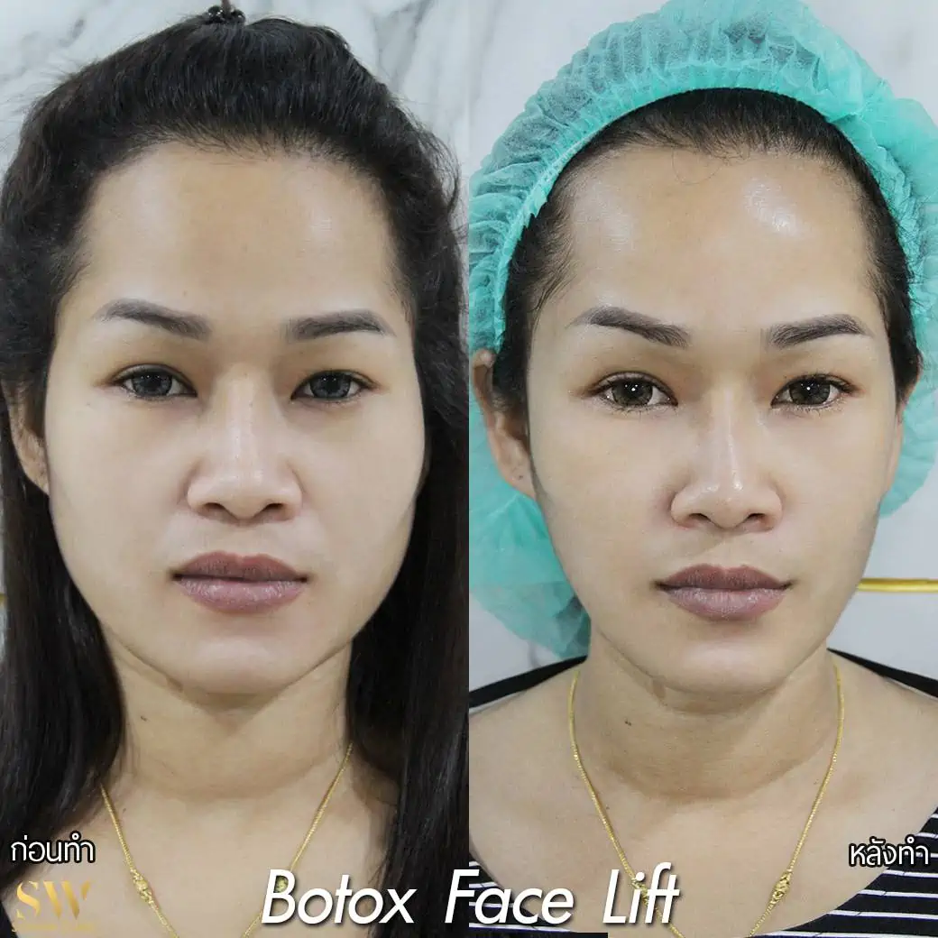 Botox Facelift โซวอน