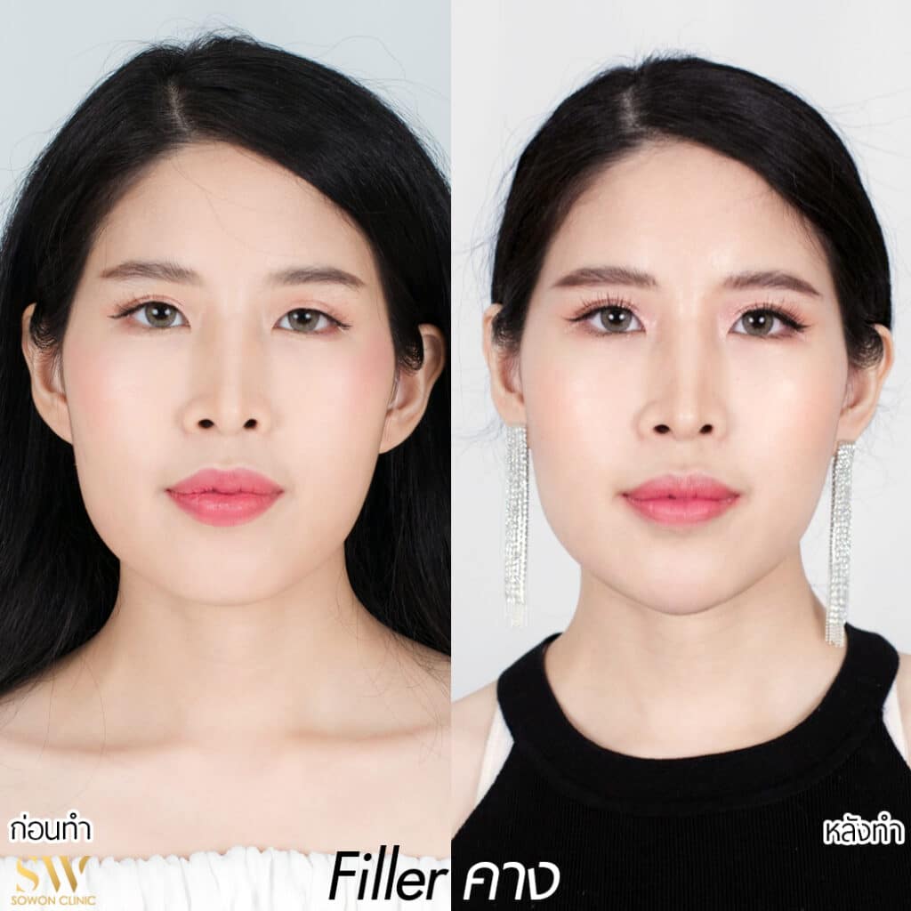 Fillerคาง หลังฉีด1เดือน