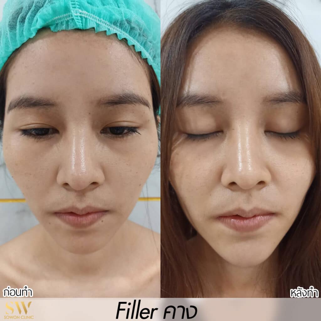 Fillerคาง รีวิวจากลูกค้า