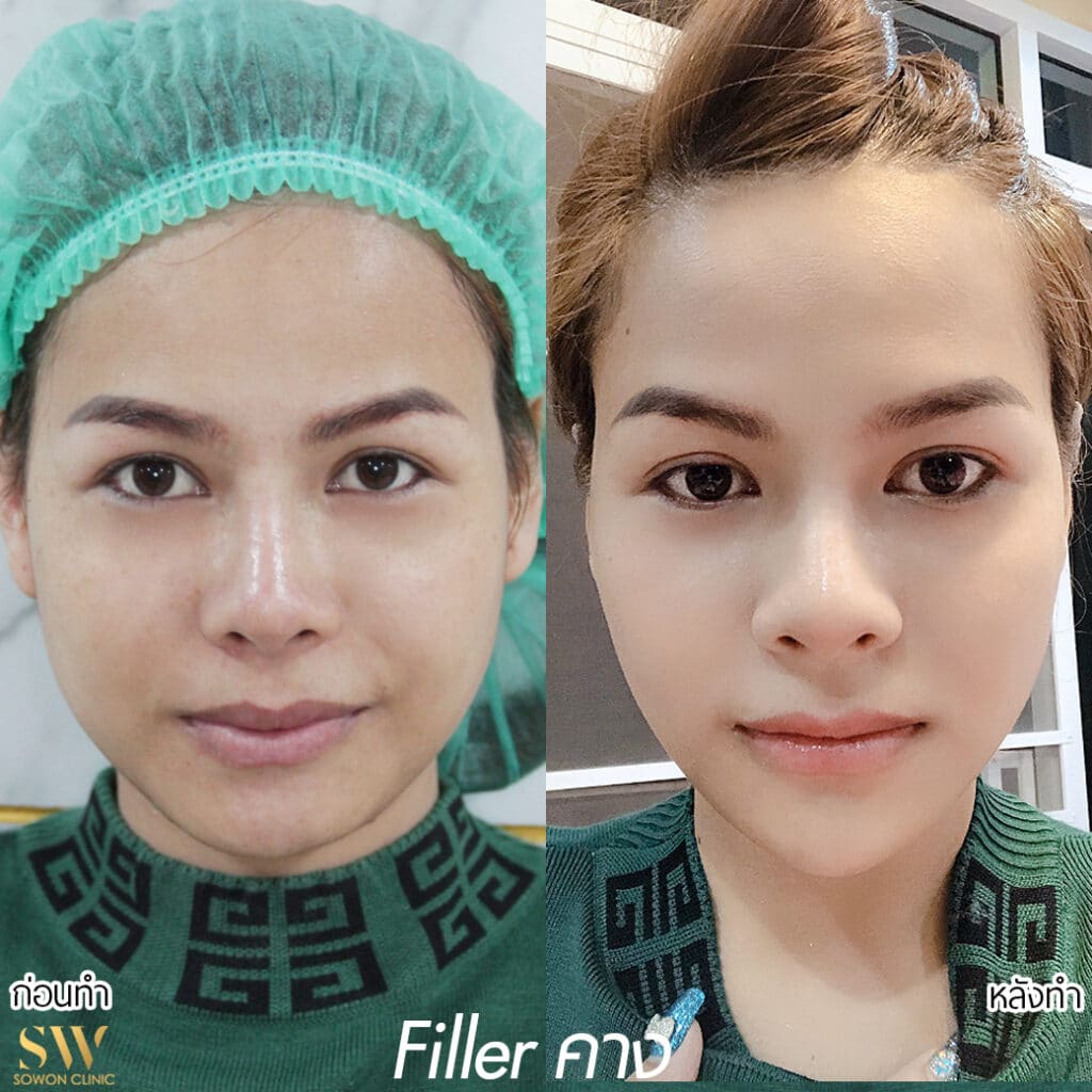 Fillerคาง รีวิว