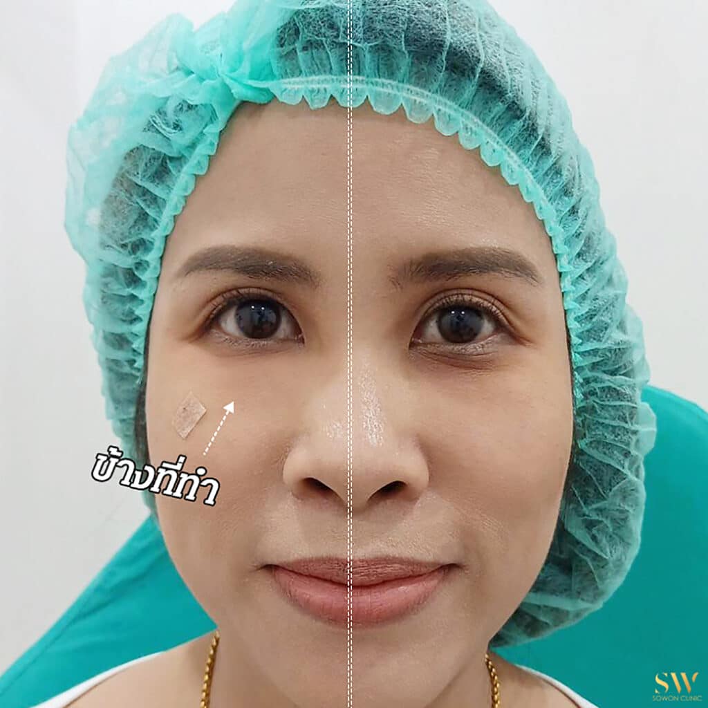 ฉีด Filler ใต้ตา
