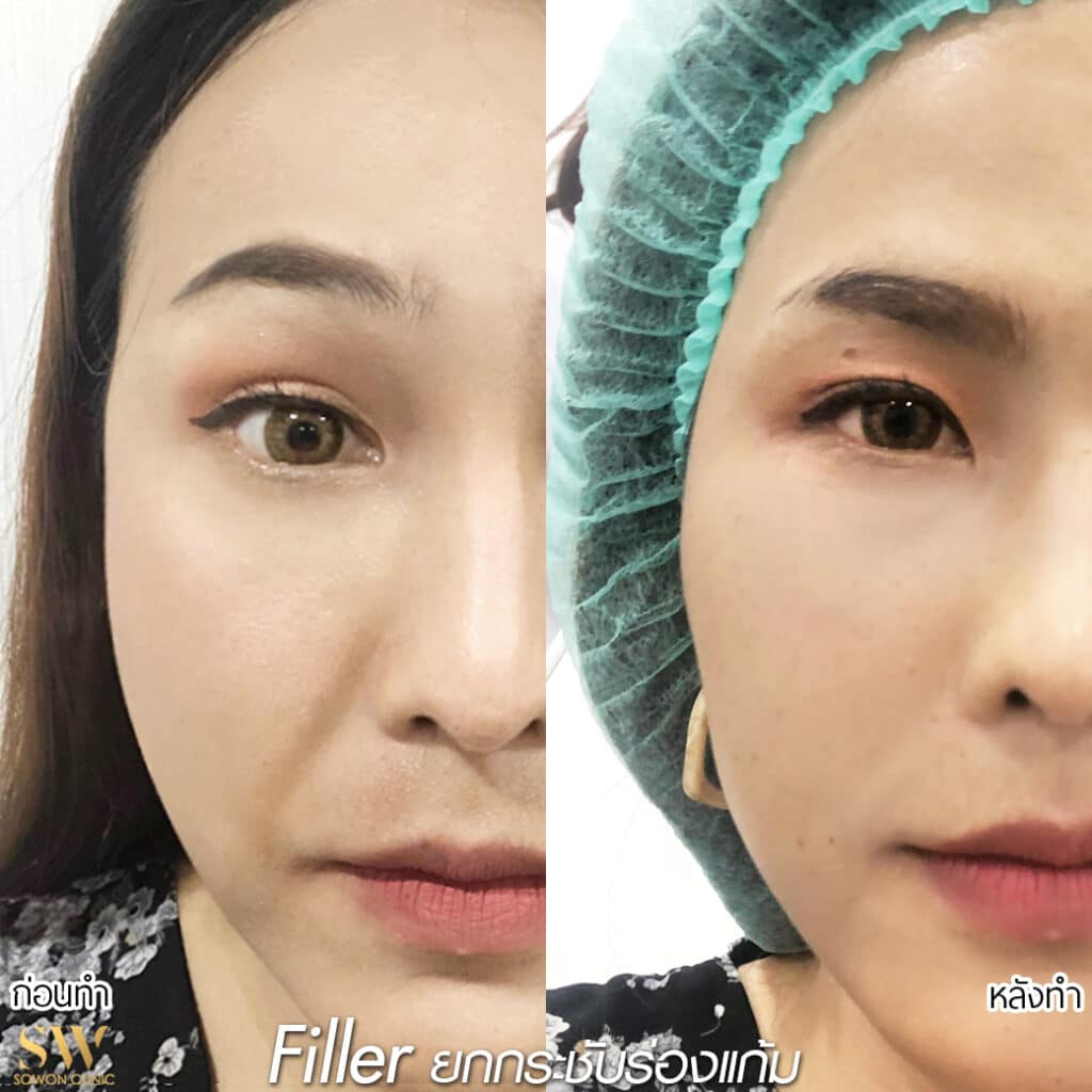 Fillerยกกระชับ
