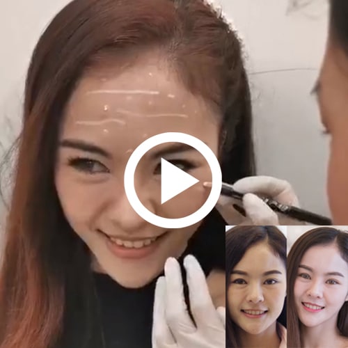 vdo รีวิวลดริ้วรอย ลดกราม