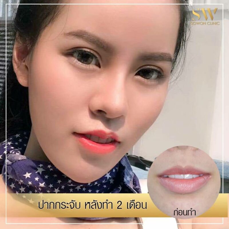 รีวิวปากกระจับ โซวอน รีวิวปากกระจับ โซวอน