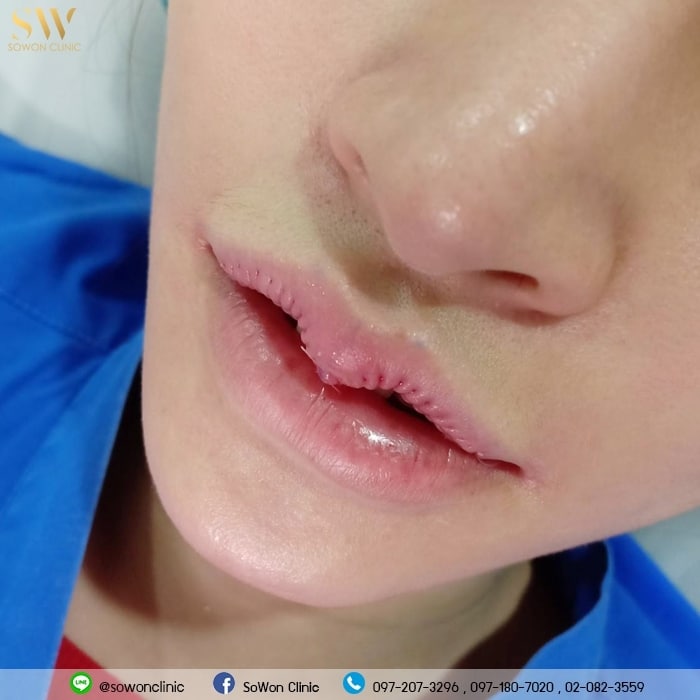รีวิวปากกระจับสวยๆ sowon clinic