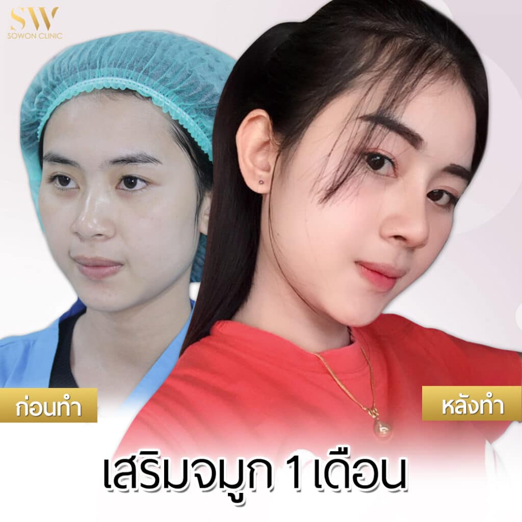 จมูกทรงดารา
