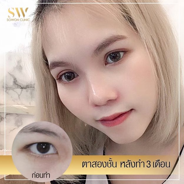 ตาสองชั้น โซวอนคลินิก
