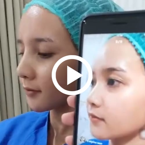 เสริมจมูกด้วยตัวซิลิโคนพรีเมี่ยม