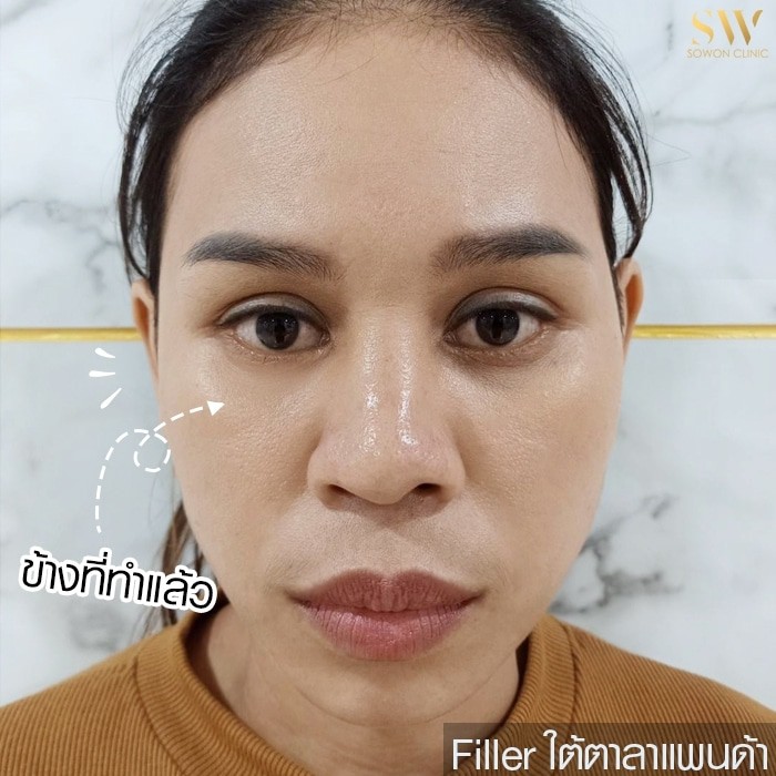 ฟิลเลอร์ใต้ตา