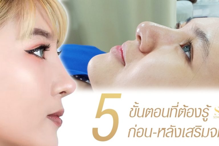 เสริมจมูก ต้องทำอย่างไร? 5 ขั้นตอนที่ต้องรู้ก่อนและหลังเสริมจมูก