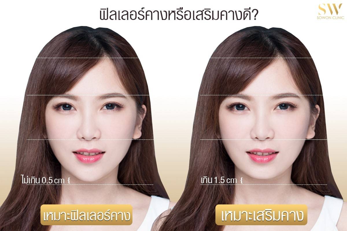 ฟิลเลอร์คาง หรือเสริมคาง แบบไหนดีกว่ากัน?
