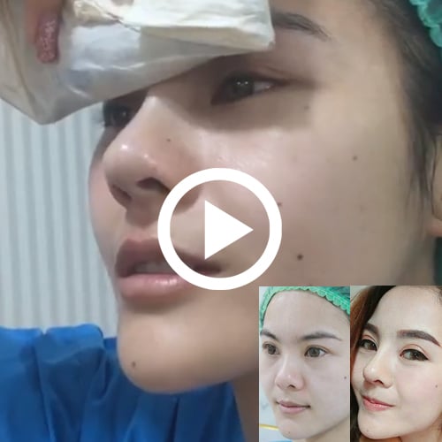 vdo รีวิวเสริมจมูก คุณส้มโอ