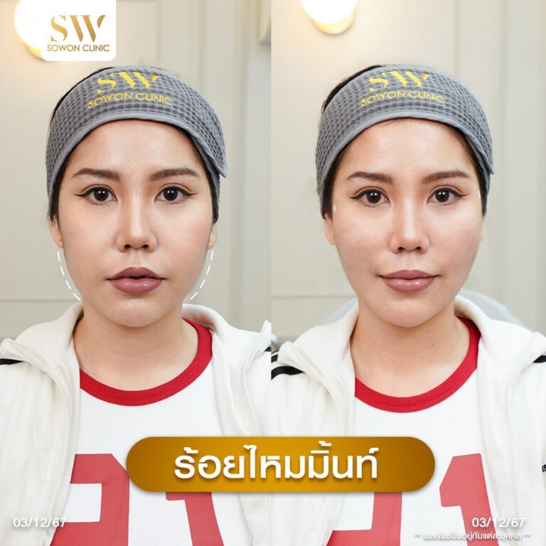 รีวิวร้อยไหม ลุกสาวโซวอน03