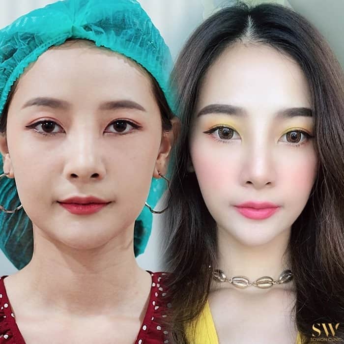 ลดกราม โบท็อกซ์
