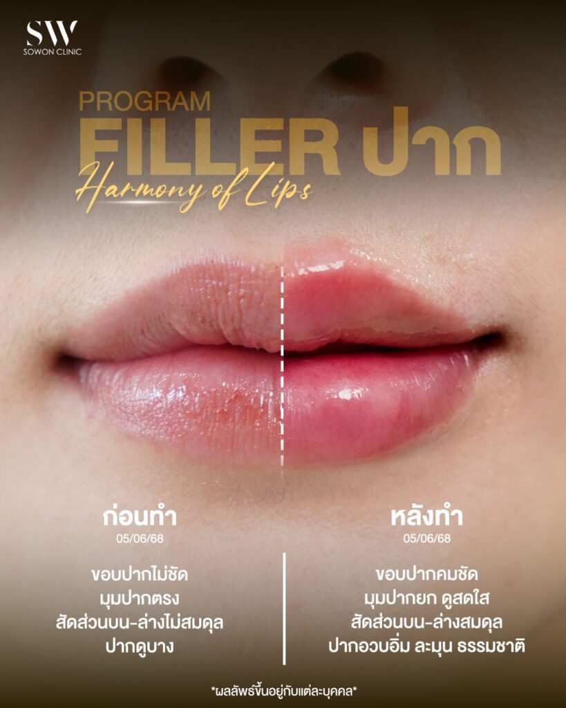 ก่อน fillerปาก ข้อห้ามหลังฉีดฟิลเลอร์ปาก ก่อนหลัง