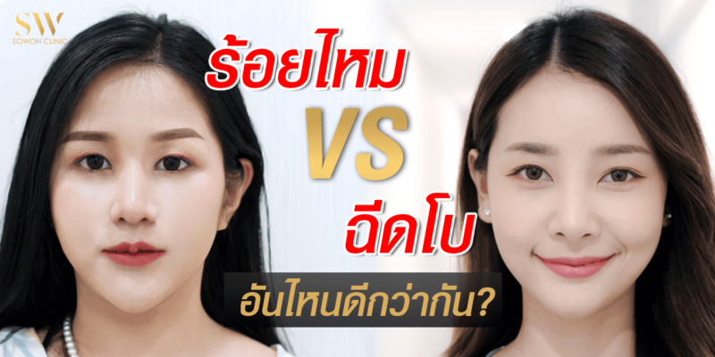 ร้อยไหมกับฉีดโบ