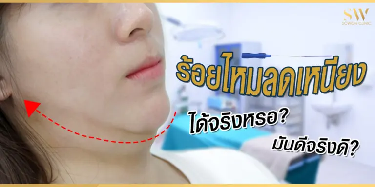 ร้อยไหมลดเหนียง