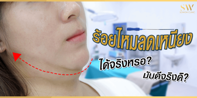 ร้อยไหมลดเหนียง