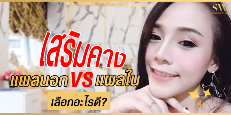 เสริมคางแผลนอกหรือแผลใน