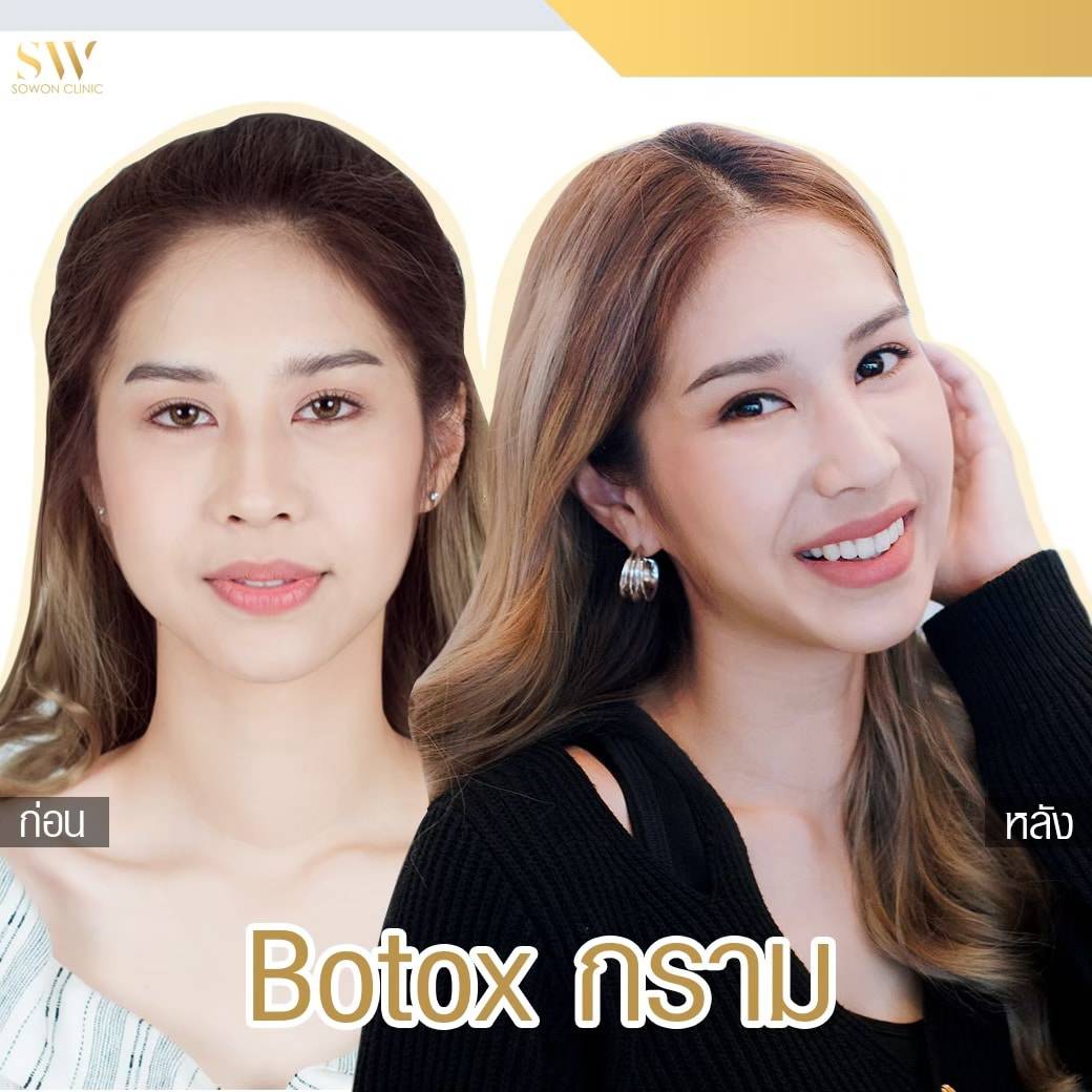 Review Botox โบท็อกซ์ลดกราม