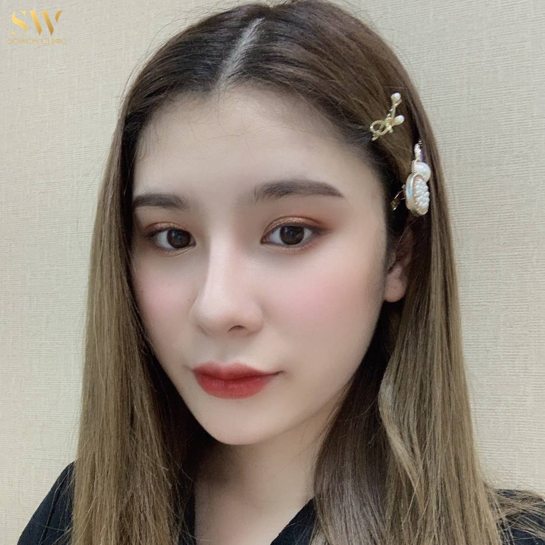 ฉีดโบท็อกซ์ ลดกราม