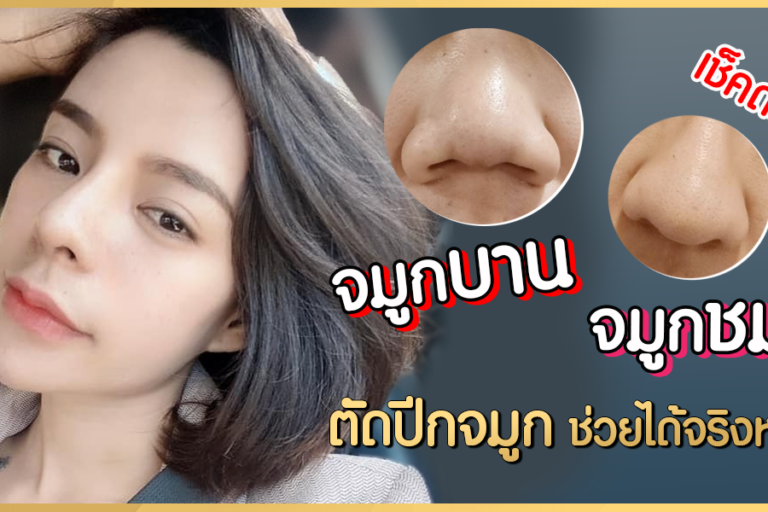 จมูกบาน จมูกชมพู่ ตัดปีกจมูก ช่วยได้จริงหรอ