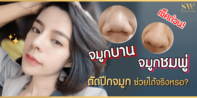 จมูกบาน จมูกชมพู่ ตัดปีกจมูก ช่วยได้จริงหรอ