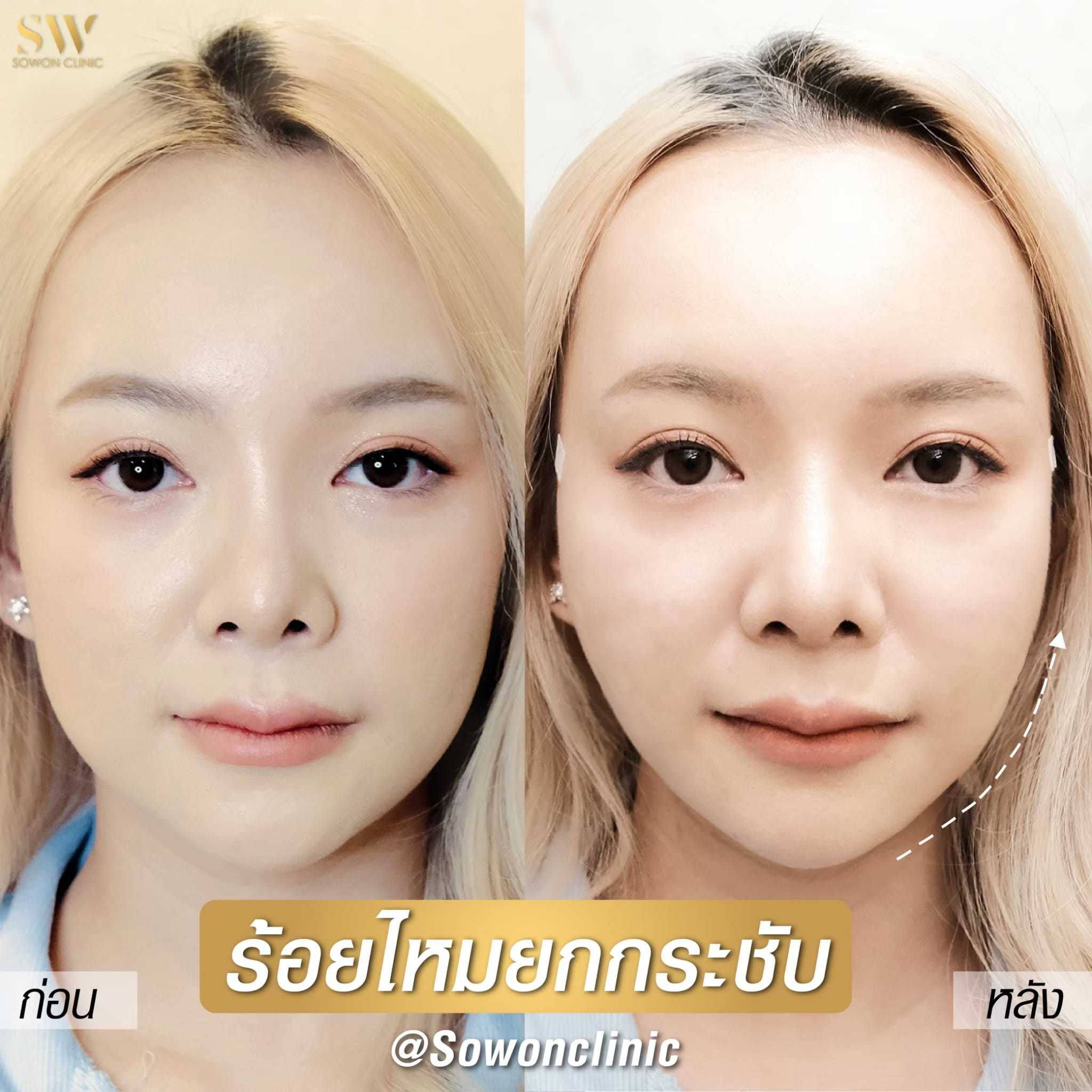 ร้อยไหม