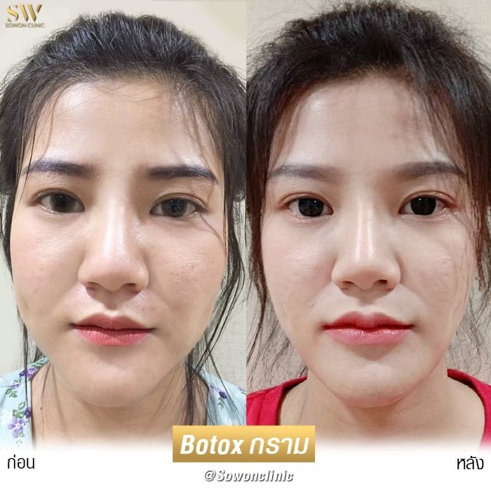 โบท็อกซ์