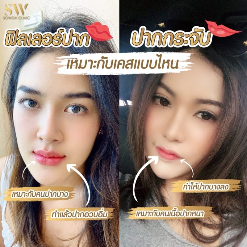 ฟิลเลอร์ปาก ปากกระจับ