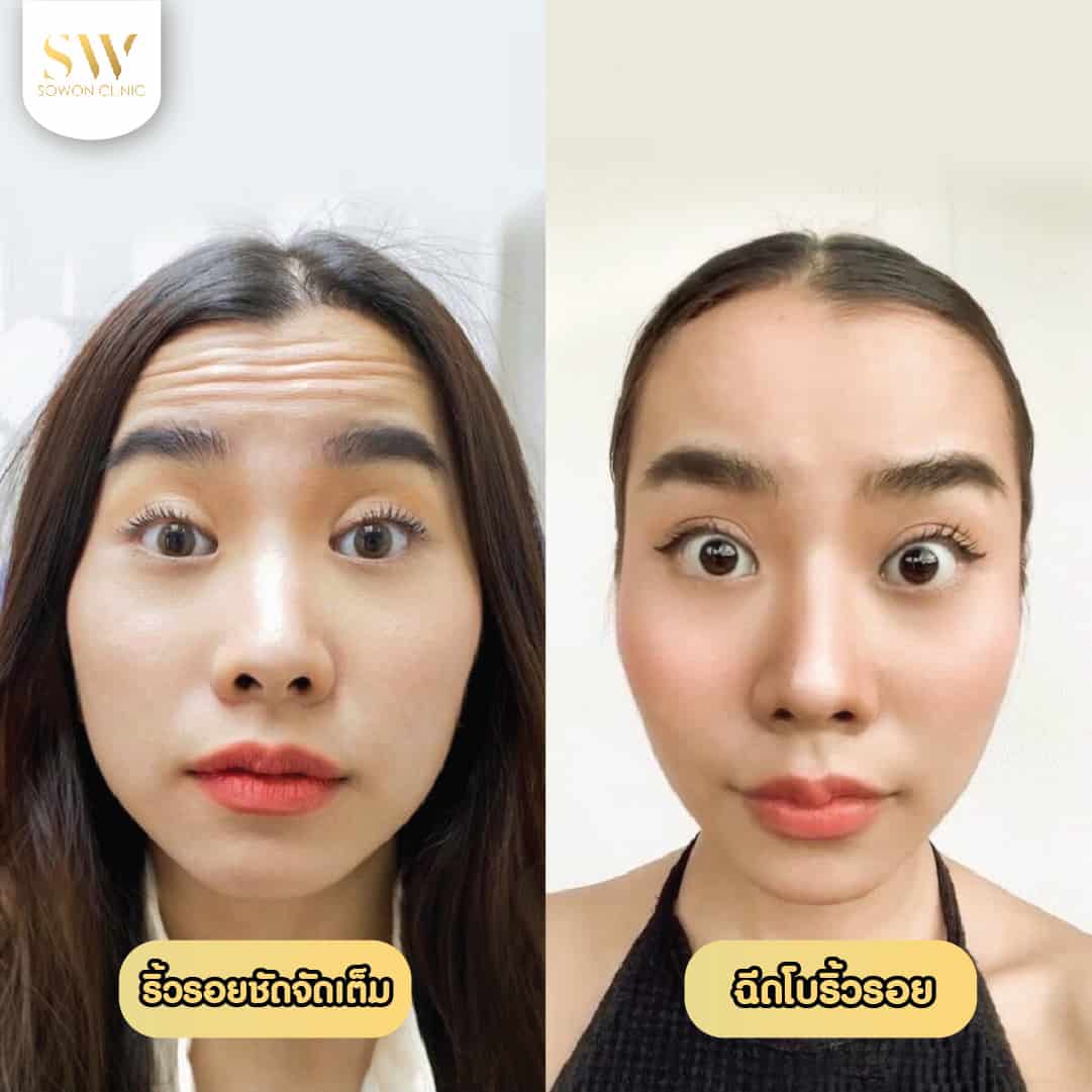 ฉีดโบท็อก