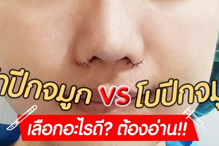 ตัดปีกจมูกดี