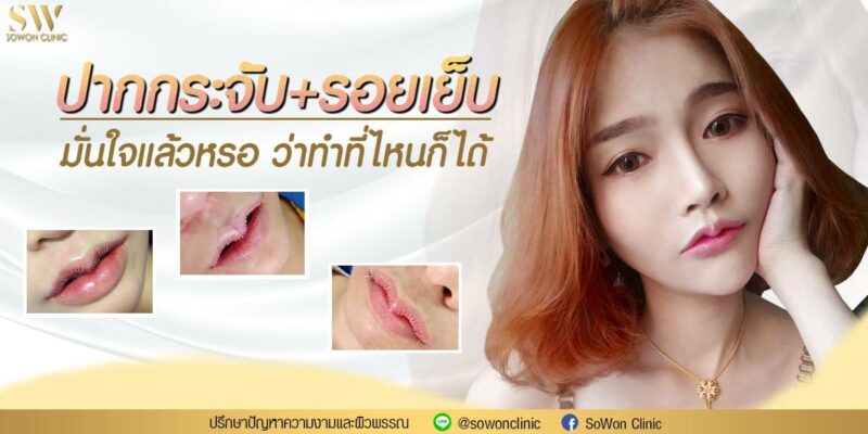 ปากกระจับ รอยเย็บ ปาก
