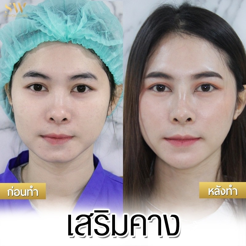 เสริมคางโซวอน