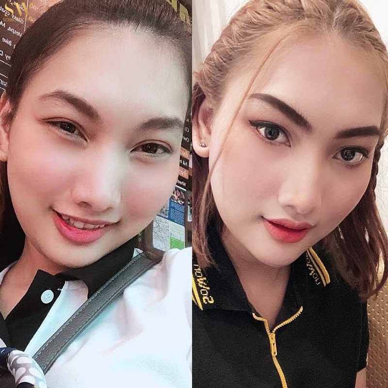เสริมคางโซวอน