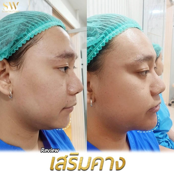 เสริมคางโซวอน