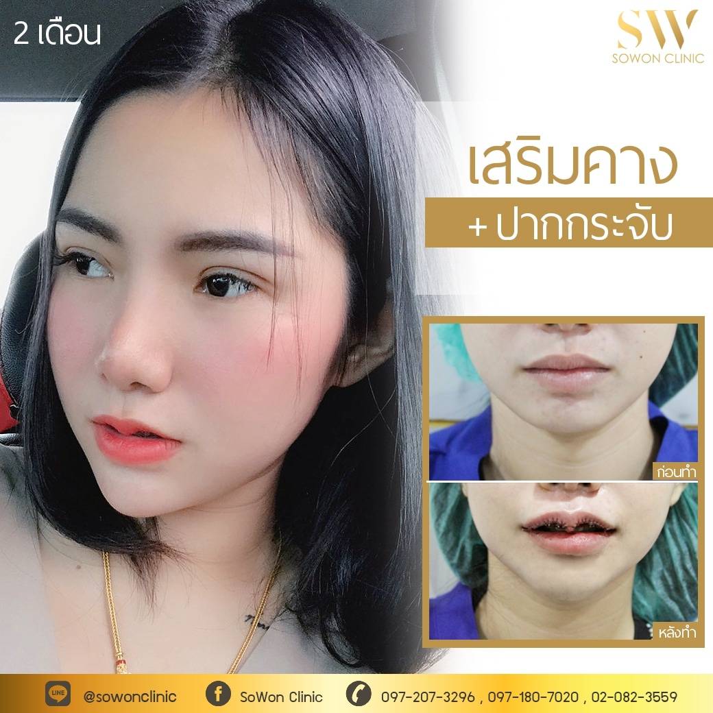 เสริมคางโซวอน