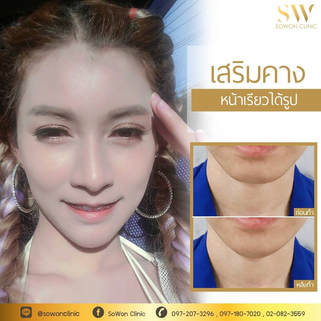 เสริมคางโซวอน