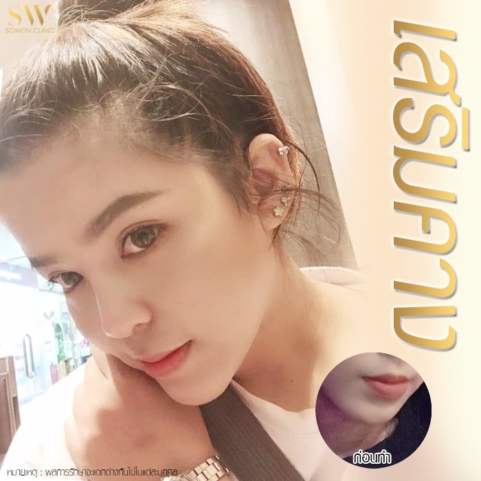 เสริมคางโซวอน