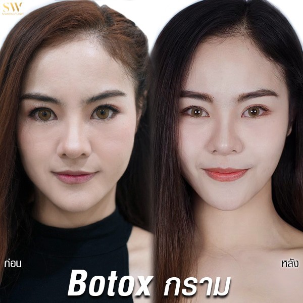 Botoxกรามส้มโอ