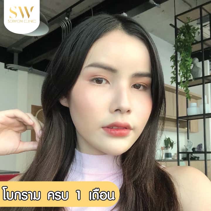 ฉีดโบท็อก