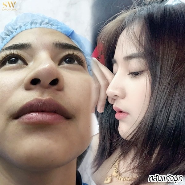 แก้จมูก โซวอน