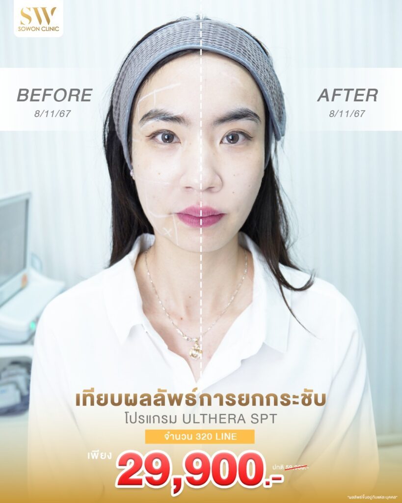 โปรโมชั่น Ulthera หน้าเรียว หน้ายก ulthera 