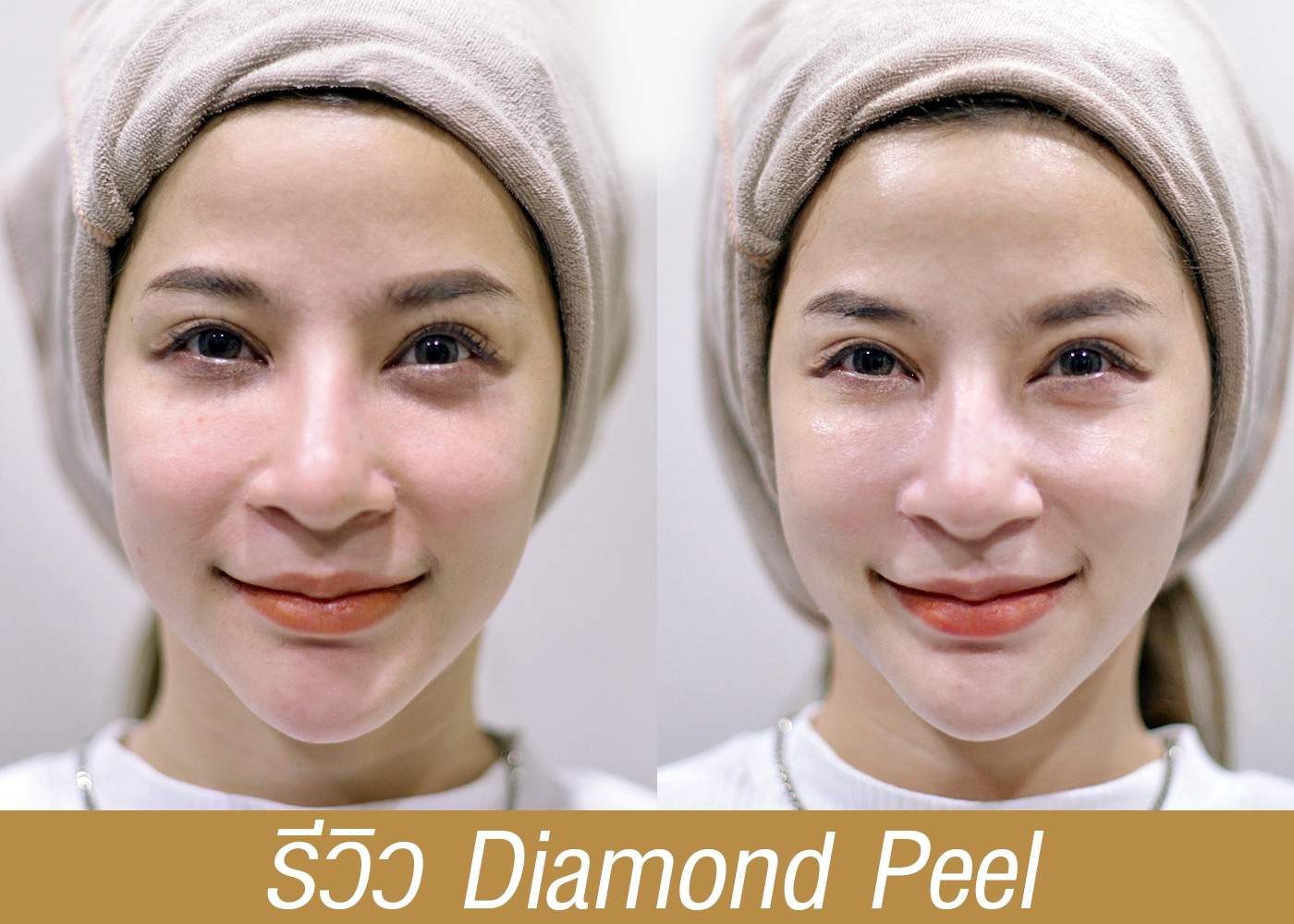 diamond peel เรื่องผลัดเซลล์ผิว