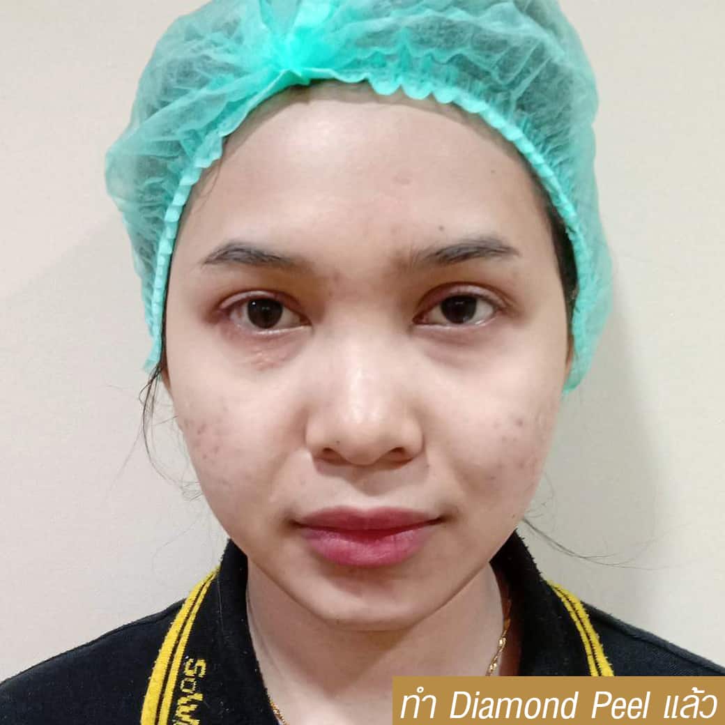 diamond peel เรื่องผลัดเซลล์ผิว