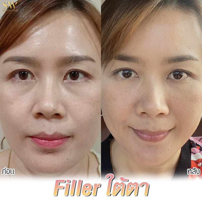 review filler sowon clinic 2021