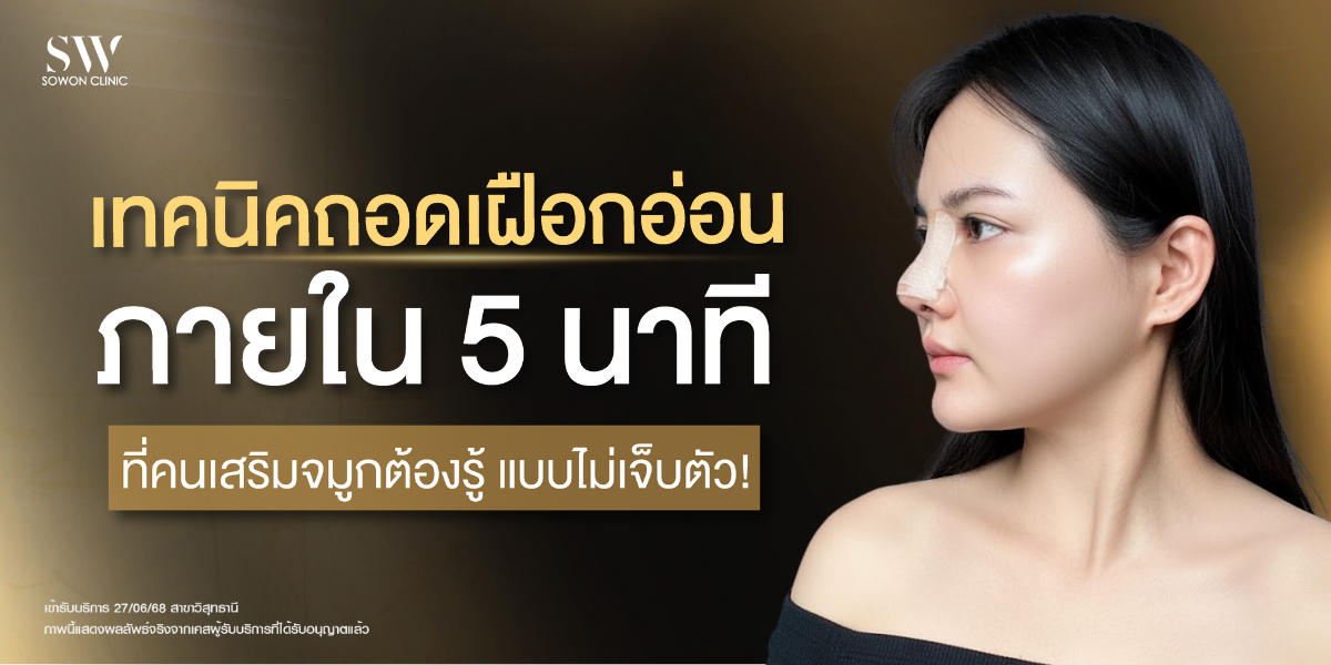 ถอดเฝือกจมูก เสริมจมูก เฝือกอ่อน