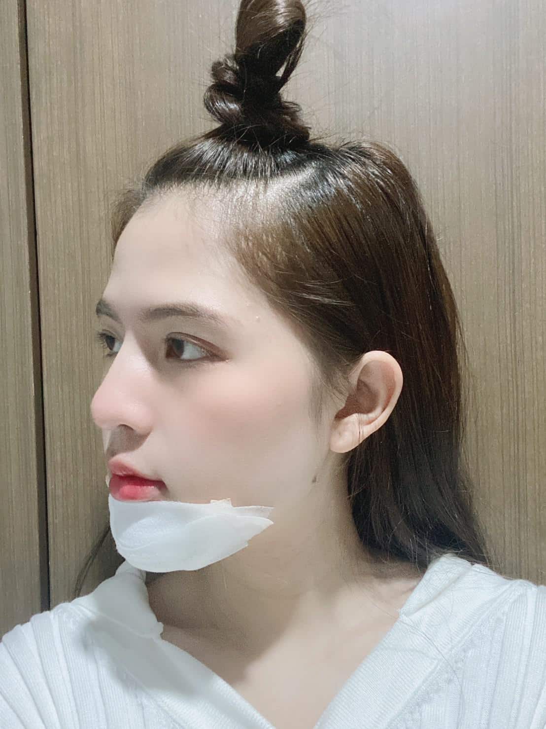 Chin Augmentation Review day7